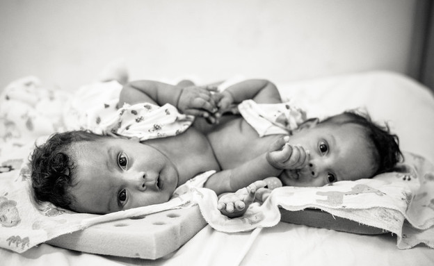 תאומות סיאמיות (צילום:  Mateus André Photography)