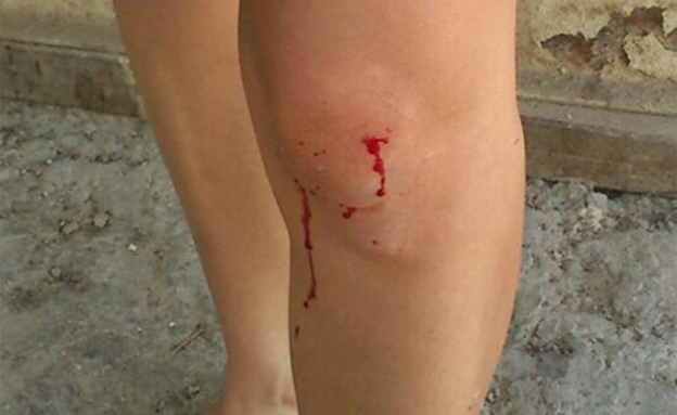 האישה נפצעה קל ברגלה (צילום: ביטחון תקוע)