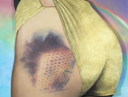 שטפי דם אמנותיים