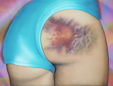 שטפי דם אמנותיים