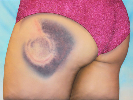 שטפי דם אמנותיים