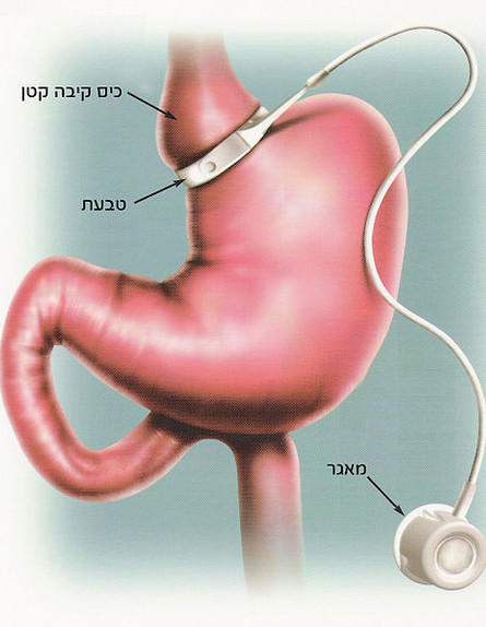 ניתוח הצרת קיבה (צילום: wikipedia user: ד"ר אסנת רזיאל)