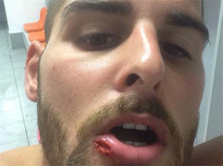למרות המגן, הצליח להיפצע בפנים (אלן שיבר) (צילום: ספורט 5)