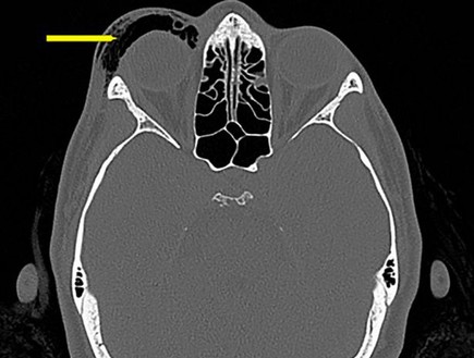 התעטשה והתעוורה (צילום: BMJ Case Reports)