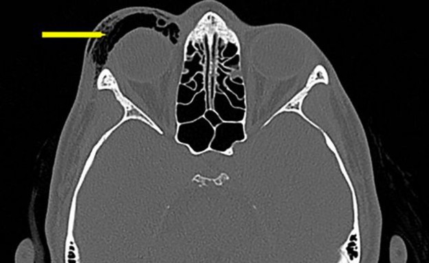 התעטשה והתעוורה (צילום: BMJ Case Reports)