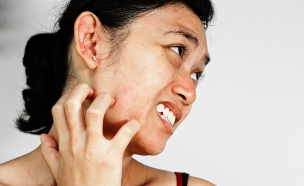 אישה מגרדת עקיצת יתוש (צילום: Shutterstock, מעריב לנוער)