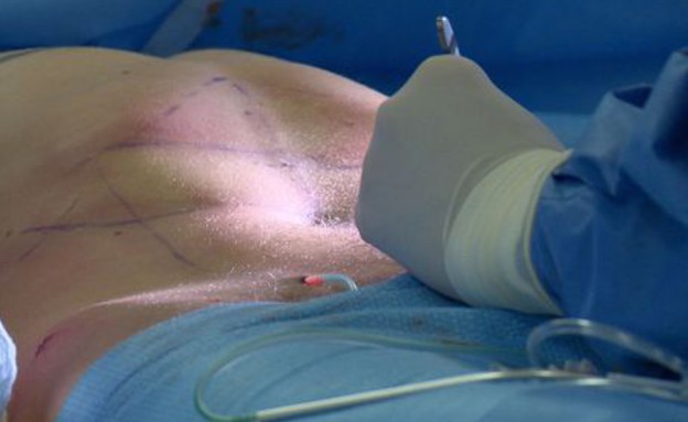 לי קופלנד עבר ניתוח להשתלת קוביות (צילום: bbc)
