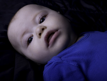 אדי ילד עם מחלה נדירה (צילום: huffingtonpost.com)