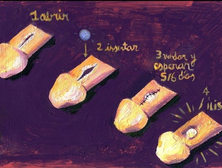 ניתוח פנינה