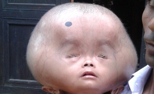 תינוק ראש נפוח (צילום: Exclusivepix)
