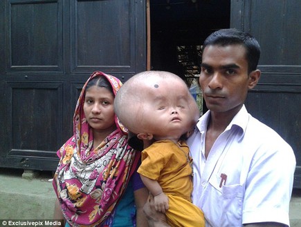 תינוק ראש נפוח (צילום: Exclusivepix)