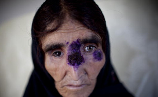 התפשטות מחלת הלישמניאזיס (צילום: AFP, GettyImages IL)