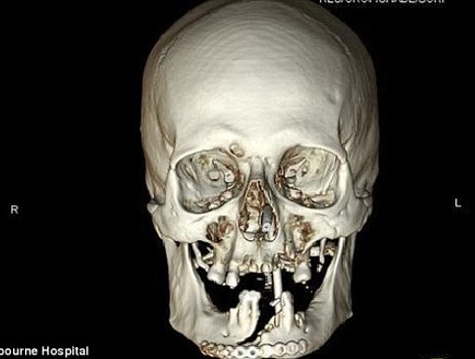 ניסר את פניו