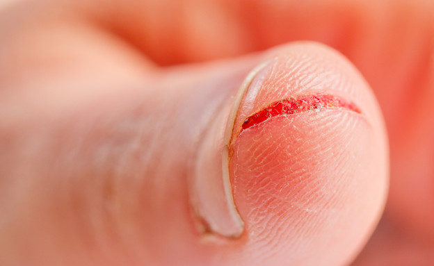 חתך באצבע (צילום: Shutterstock/FCG)