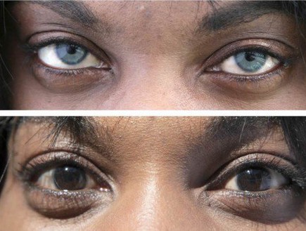 ניתוח צבע העיניים (צילום: BrightOcular)
