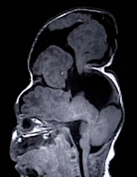 מוח מחוץ לגולגולת (צילום: Boston Children’s Hospital)