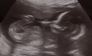 הריון חוץ רחמי (צילום: dailymail.co.uk)