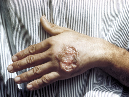שושנת יריחו | לישמניה (צילום: wikimedia user: CDC/ Dr. D.S. Martin)