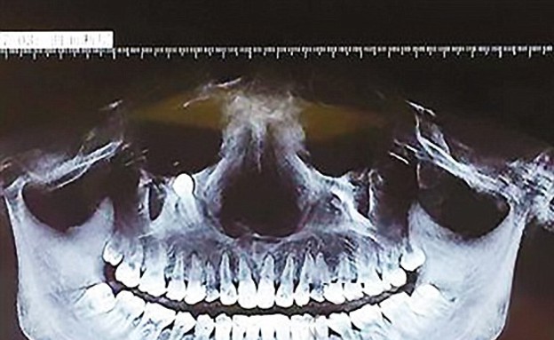 שן בעין (צילום: CEN)