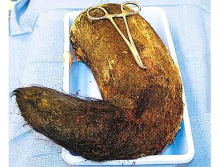 חפצים בגוף האדם