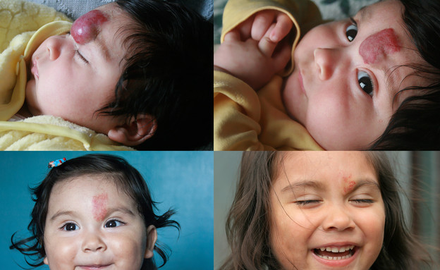 המנגיומה לפני ואחרי טיפול (צילום: Shutterstock)