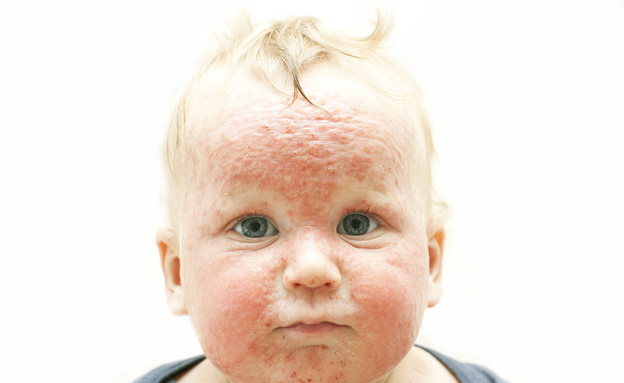 דלקת עור אטופית (צילום: Shutterstock)