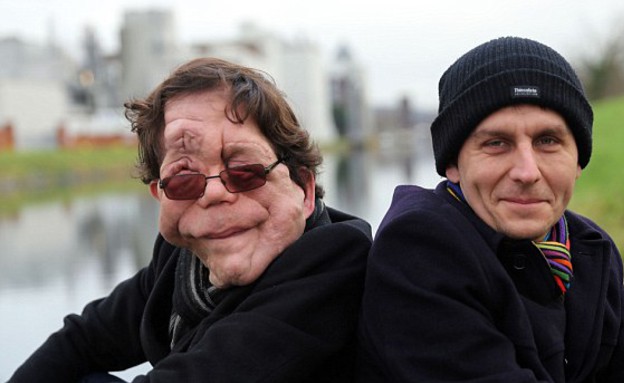 תאומים זהים עם מום (צילום: BBC)