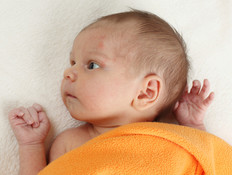 תינוק עם פצעונים על פניו (צילום: אימג'בנק / Thinkstock)