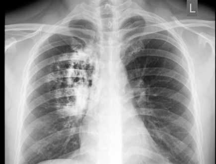 סרטן הריאות (צילום: wonderisland, Shutterstock)