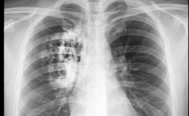 סרטן הריאות (צילום: wonderisland, Shutterstock)