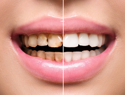 שיניים (צילום: Shutterstock)