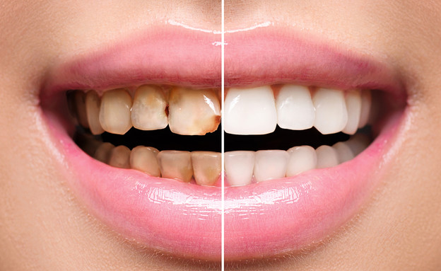שיניים (צילום: Shutterstock)