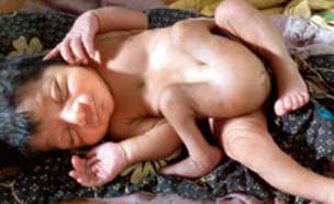תינוק הרבה איברים (צילום: Times of India)