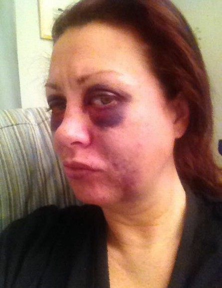 קרוליין ווי, העלתה תמונות סלפי בעקבות התקיפה (צילום:  Photo by Flash90)