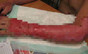 הוכה על ידי ברק - וחושף את הפציעות המזוויעות (צילום: יחסי ציבור)