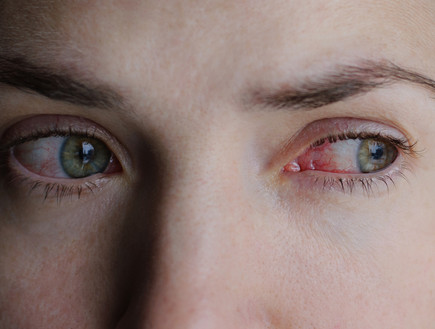 עיניים אדומות (צילום: Domaskina, Shutterstock)