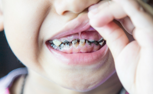 עששת בשיניים (צילום: Noppadon stocker, Shutterstock)
