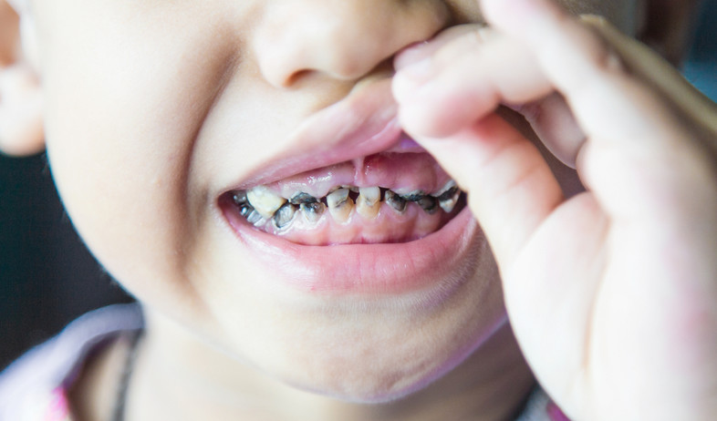 עששת בשיניים (צילום: Noppadon stocker, Shutterstock)