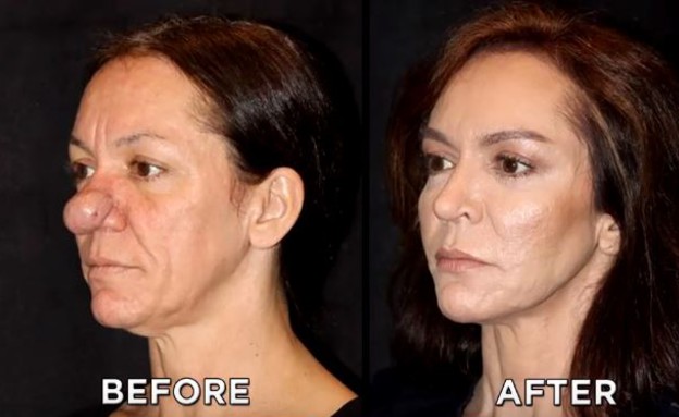 פמלה ניתוח אף לפני ואחרי (צילום: Youtube/The Doctors)
