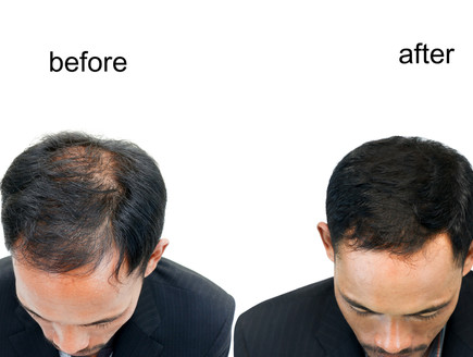 השתלת שיער: לפני ואחרי (צילום: shutterstock:  chairoij)