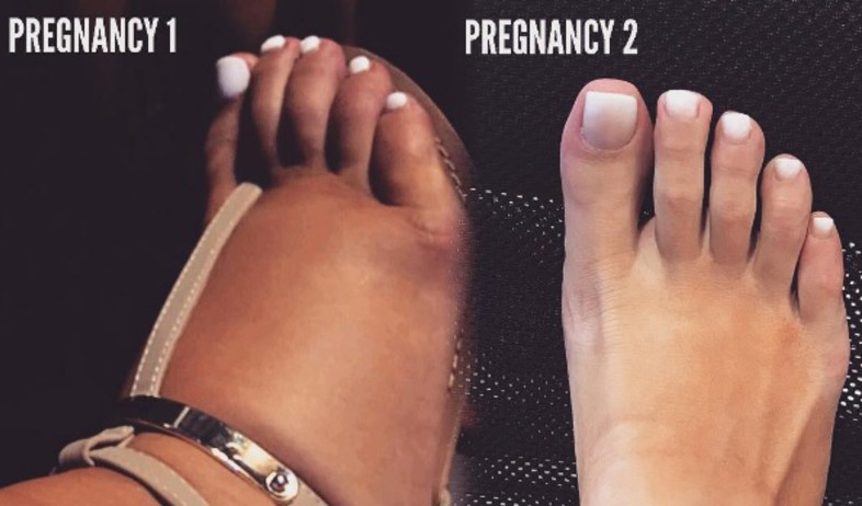 בצקות בהריון ראשון ושני (צילום: מתוך instagram)