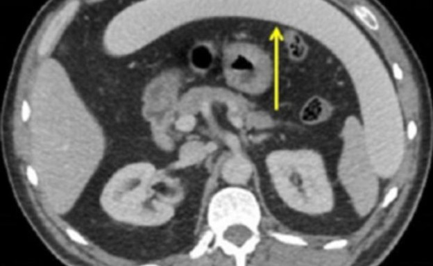 לילה קינקי (צילום: BMJ Case Reports)