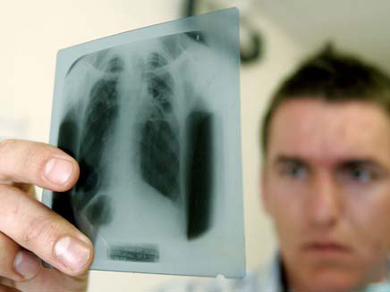 ירידה בסרטן הריאות (צילום: AP)