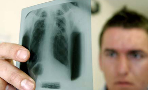 ירידה בסרטן הריאות (צילום: AP)