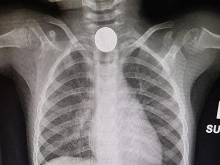 צילום הרנטגן של המטבע בגרון הילדה (צילום: מכבי שירותי בריאות)