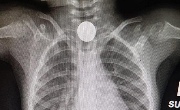 צילום הרנטגן של המטבע בגרון הילדה (צילום: מכבי שירותי בריאות)