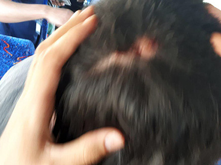 אחד המתיישבים שנפצעו במהלך הפינוי (צילום: חדשות)