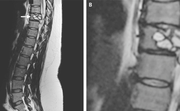 רנטגן עמוד השדרה (צילום: (M, Jacquier, L Piroth (New England Journal of Medicine)