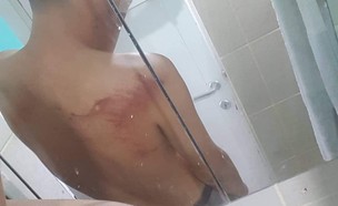 חבלות הצעיר (צילום: פרטי)