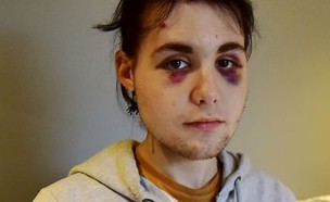 בן ה-18 שהותקף על רקע הומופובי (צילום:  Photo by Flash90, מתוך פייסבוק)